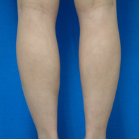 BX leg before.jpgのサムネール画像